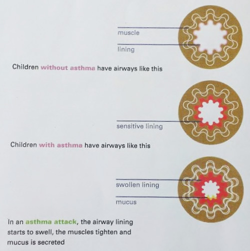 Asthma In Children Dubai | https://www.pediatriciandubai.blog/pediatrician-in-dubai/asthma-in-children-dubai/ Be Conscious Of Triggers To Better Manage Your Child's Asthma Through Medication