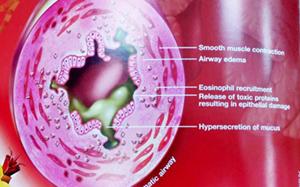 Asthma In Children Dubai | Be Conscious Of Triggers To Better Manage Your Child's Asthma Through Medication